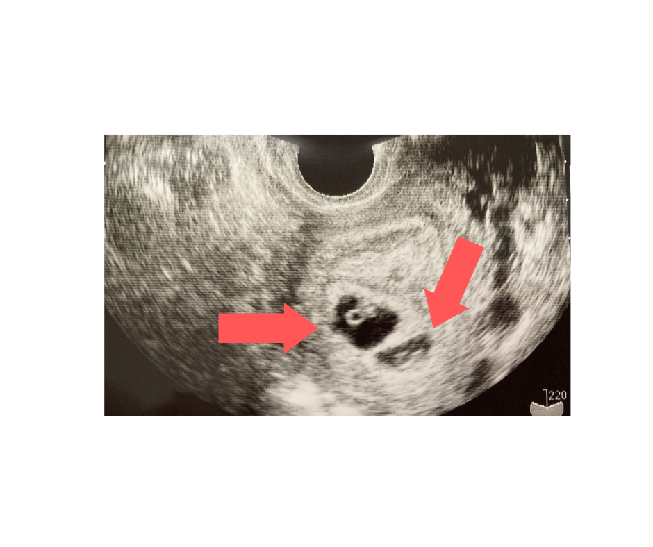 妊娠6週あたりの双子のエコー写真
